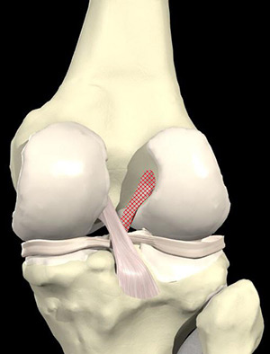 Anterior cruciate ligament or ACL 
