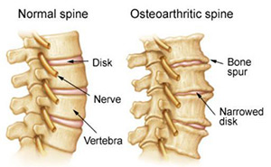 Spinal osteoarthritis